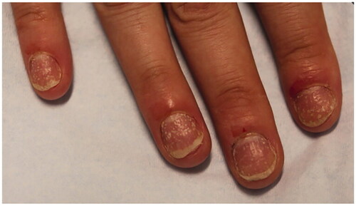 Figure 10. Nail pitting and onycholysis in right fingernails [Citation20].