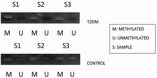 Figure 6. Represents the methylation status of SCP 2 promoter region in type 2 DM samples and the control samples by methylation sensitive PCR (MSP).