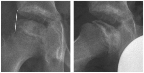 Figure 5. At 1 year. Moderate extrusion. Anterior flattening. Stage IIIa.A proximal varus osteotomy was performed 1 month later.