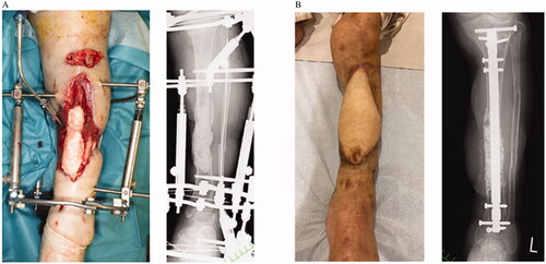 Figure 4. Case 2: (A) Preoperative clinical and radiographic findings. (B) Postoperative findings at six months.
