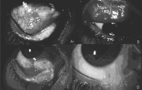Figure 1 Initial right eye slit-lamp examination. The nasal bulbar and inferior conjunctivas (A) and the superior tarsal conjunctiva (B) had plaque-like ulcerations. The initial conjunctival ulceration was followed by a recurrence of the inferior tarsal ulcer (C). A nasal symblepharon remained as a sequela after a 9-month followup (D).