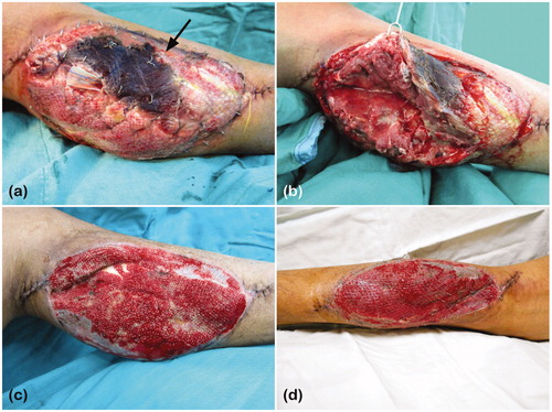 Figure 1. (a) Necrosis of the medial head of gastrocnemius on the left leg, indicated by the black arrow: loss of the skin graft over the area of muscle necrosis; (b) Pus formation was also noted under the necrotic muscle. (c) The wound had granulated well for STSG coverage. (d) Three days after STSG coverage and NPWT application.