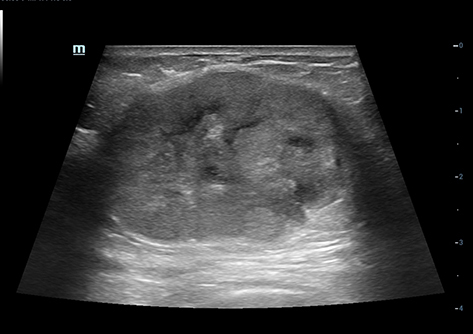 Figure 4 MUMPC, 69-year-old female patient, cystic-solid mixed echo pattern, regular shape, fairly smooth edges, enhanced posterior echo. Scattered small anechoic areas can be seen inside with enhanced posterior echo, and a “halo sign” can be seen around it.
