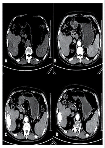 Figure 1. Male patients, 57, primary liver cancer. Patients with preoperative CT scan of the right liver lobe low-density lesions, boundary is not clear, Size of 7.0 * 3.8 cm (A). Enhanced CT of the right liver lobe lesions early uneven arterial enhancement (B).With conventional therapy and oral path for 3 months after, the CT in tumor iodine oil deposits are good in the oven, enhanced scan did not see lesions.Curative effect evaluation for CR (C); Follow-up of 12 months after treatment tumors had the previous narrow (5.0× 2.7 cm), enhanced scan within tumors had no reinforcement (D).