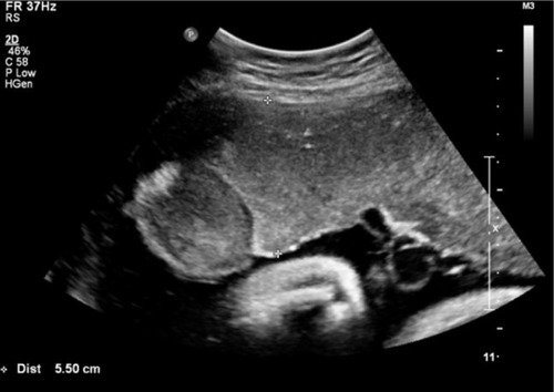 Figure 2 A gray-scale ultrasound image shows the protruding placental mass into the amniotic cavity from a placenta with the thickest anteroposterior diameter of 5.5 cm.