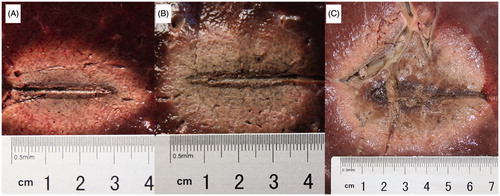 Figure 3. Ablation zones and diameter measurements after radiofrequency ablation (RFA) in ex vivo bovine livers, using a monopolar, internally cooled electrode at 200 W for 15 min. (A) RFA without injection (3.80 cm longitudinal ×2.70 cm transverse diameters); (B) RFA with 38.5% sodium chloride (NaCl) injection (4.10 cm longitudinal ×3.20 cm transverse diameters); (C) RFA with 10% hydrochloric acid (HCl) injection (5.80 cm longitudinal ×5.50 cm transverse diameters). The ablation zones from RFA-alone and NaCl-RFA oval, with thin, dark brown carbonization bands distributed along the electrode tracts. In contrast, ablation zones from HCl-RFA were more spherical, with expanded central ‘silt-like’ (similar to moist sediment) regions.