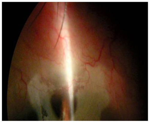 Figure 2 Less-vascularized failing, elevated bleb after first needling and 5-FU injection.