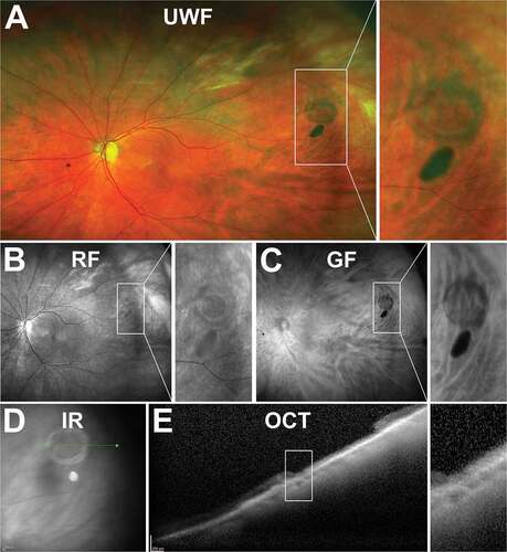 Figure 14. 84-year-old Caucasian male with operculated retinal hole. (A) UWF imaging, (B) red and (C) green-free and (D) infra-red imaging show a round lesion with a surrounding cuff and an adjacent operculum. (E) Peripheral OCT highlights the flat profile of the full-thickness hole with no associated subretinal fluid. Abbreviations as in Figure 3.