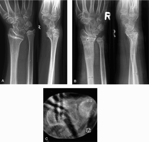 Figure 3. Patient 2. Before (A) and after (B) correction of the distal radius deformity of the right forearm. The radial growth plate was partially closed (> 50%) at the time of correction and the ulnar growth plate was at stage G according to the Tanner and Whitehouse scale. The DRUJ was reduced anatomically in the low‐dose CT at the end of correction (C).