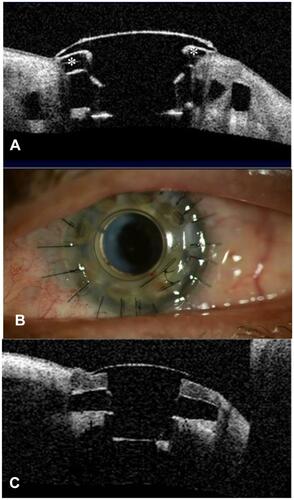 Figure 2 Patient with implanted type 1 Boston keratoprosthesis. (A) Anterior segment OCT showing sterile corneal melt. There is evidence of back plate exposure (*). (B) One week after graft replacement without removing the keratoprosthesis for the treatment of corneal melt. (C) Postoperative anterior segment OCT showing good graft apposition with the KPro optical stem in the same patient.
