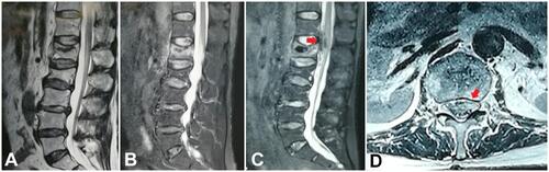 Figure 1 Although the L1 and L2 vertebra are wedge shaped at the T2 weighted imaging of magnetic resonance imaging (MRI) (A), the high signal of the short time inversion recovery (STIR) sequence was only seen in the L1 vertebral body (B). Twelve hours after the PKP, a high signal aggregation in front of the spinal cord from T12 to L1 was detected at the sagittal ((C), red arrow) plane of MRI examination, which gathered in the left part of the spinal canal at the axial plane of MRI ((D), red arrow).