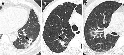 Figure 2. ( A) Some large bronchi are surrounded by a GGO located in the left lower lobe of the lung (black triangle). (B) A GGO in contact with a large bronchus (black triangle). (C) A pure GGO surrounding a few bronchi and vessels (white arrowheads).