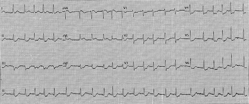 Figure 1. Electrocardiogram demonstrated atrial fibrillation with a rapid ventricular response rate and ST-segment depression in leads II, III, aVF, and V1 to V5. Scale: 25 mm/s; 10 mm/mV.