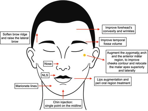 Figure 3 Treatment options for transgender facial feminization with hyaluronic Acid.