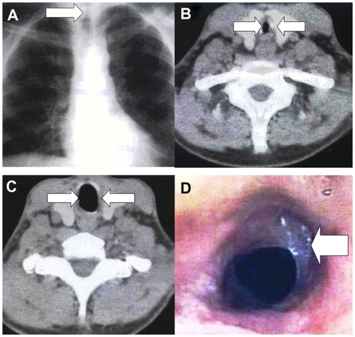 Figure 1 (A) Chest X-ray upon admission. (B) Computed tomography scan of neck upon admission. (C) Computed tomography scan of neck post-laser intervention and systemic treatment. (D) Bronchoscopic findings demonstrating (web-like) fibrotic stenosis.