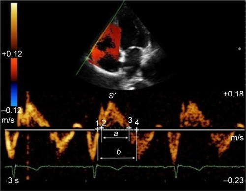 Figure 2 Measures of the myocardial performance index using tissue Doppler (MPIt) and peak velocity at the annulus (S′).