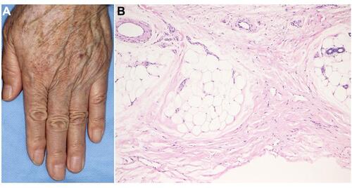 Figure 8 (A) Scleroderma showing edematous fingers of an oral melanoma patient under nivolumab therapy. (B) Histopathology showing thickened collagen bundles in the lower dermis.