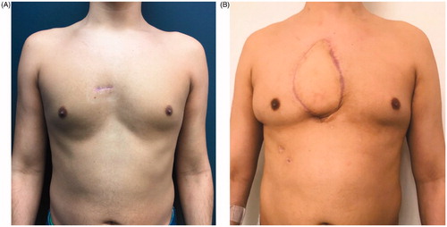 Figure 5. Comparison of the preoperative situation, which shows a small scar from the sternal biopsy at the presternal area (A), to the result four months after sternum resection and reconstruction by a polypropylene – methyl methacrylate sandwich graft and a pedicled myocutaneous latissimus dorsi flap (B).