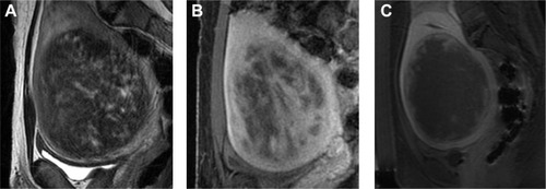 Figure 1 Sagittal MRI of a typical case pre/post treatment.