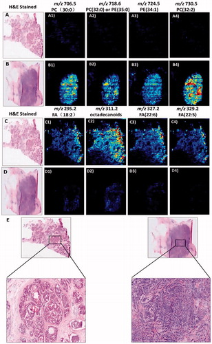 Figure 11. AFAI-MSI of samples of low-grade breast ductal carcinoma in situ (A and C) and high-grade breast invasive ductal carcinoma (B and D). Positive ion mode AFAI-MSI ion images of two samples showing the distribution of m/z 706.5 corresponding to PC(30:0) (A1, B1), m/z 718.6 corresponding to PC(32:0) or PE(35:0) (A2, B2), m/z 724.5 corresponding to PE(34:1) (A3, B3) and m/z 730.5 corresponding to PC(32:2) (A4, B4). Negative ion mode AFAI-MSI ion images of sample two samples showing the distribution of m/z 295.2, corresponding to FA(18:2) (C1, D1), m/z 311.2 corresponding to octadecanoids (C2, D2), m/z 327.2 corresponding to FA(22:6) (C3, D3) and m/z 329.2 corresponding to FA(22:5) (C4, D4). Lower magnification images with expanded views of an adjacent haematoxylin and eosin (H&E) stained section are shown in (E). Reprinted with permission from [Citation175].