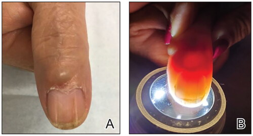 Figure 12. A, A translucent compressible nodule of the proximal nail fold and longitudinal groove in the nail plate of the right thumb. B, Transillumination using a dermatoscope to project light from the dorsal digit through the nail unit demonstrated a central nodule in the proximal nail fold as well as a second cyst radially. (Reprinted with permission from Cutis. 2020;105(2):82. ©2020, Frontline Medical Communications Inc.) [Citation73].