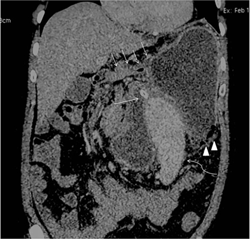 Figure 1 CECT scan showing gastric volvulus multiple intramural air foci are also confirmed (arrowheads). The cross-section of the nasogastric tube is seen (single thin arrow). The antro-pyloric canal is seen close to the fundus and below the liver (multiple thin arrows). The spleen is seen in an abnormal location anterior to the stomach (curved thin arrow).