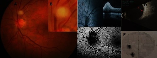 Figure 1 (A) Fundus photo on presentation showing a yellow-white mass in the retina, abruptly elevated without vessels distributed amongst the lesion. (B) High magnification image of (A). We can see details of the shape and boundary features of the lesion. (C) OCT-SD: hyperreflective smooth surface elevated retinal mass with optical shadow posterior to the lesion. (D) Ultrasound shows a mass without calcifications (arrow). (E) Fundus autofluorescence shows mild hypoautofluorescence with a small nidus of hyperautofluorescence. (F) Visual fields analysis showed an enlarged blind spot because the lesion is almost attached to the optic nerve. The visual field shows a large scotoma away from the blind spot not related to PSCRAP (encircling).