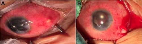 Figure 1 (A) and (B) show generalized diffuse scleritis with scleral abscess inferotemporal area.