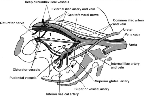 Figure 2. Extent of lymph node dissection performed: (1) external iliac, (2) obturator fossa, (3) internal iliac (hypogastric), (4) presacral.