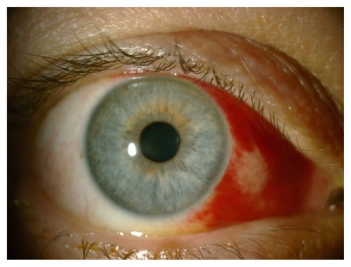 Figure 3 Traumatic subconjunctival hemorrhage involving the nasal half of the bulbar conjunctiva caused by soft contact lens wear.