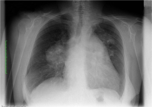 Figure 1 Standard chest X-ray on admission.