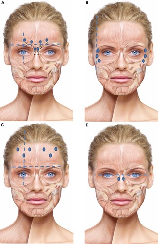Figure 1 Injection sites to treat each upper facial indication, as recommended by the expert panel.