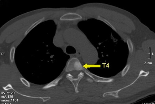 Figure 2 A 16-slice computed tomographic scan revealed a high-density nodule in the fourth thoracic vertebra.