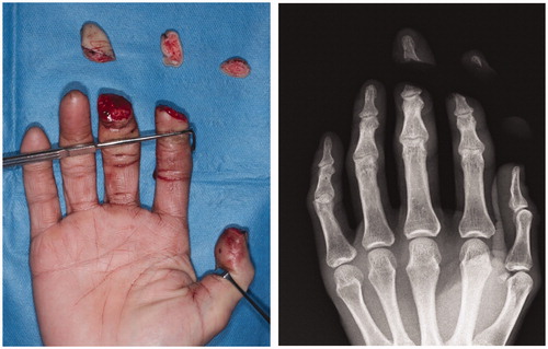 Figure 1. Fingertip amputation of the right thumb, index finger, and middle finger.