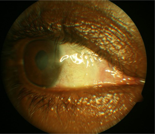 Figure 2 A year after bare sclera excision with adjunctive pre and intraoperative use of mitomycin C.