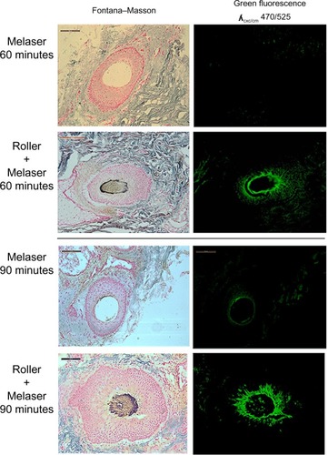 Figure 5 Presence of large deposits of melanin and fluorescein in the deeper hair follicles in the e-roller treated sites at 60 (score 6) and 90 minutes (score 8).