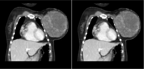 Figure 2 CT chest shows huge inhomogeneous enhanced mass at left breast.