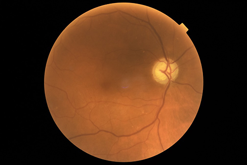 Figure 3 Funduscopic image of glaucomatous optic disc in 65-year female (right eye).