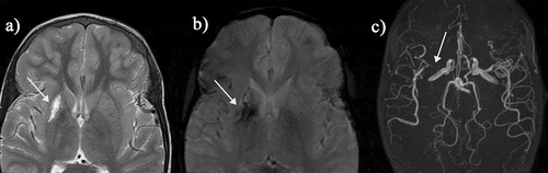 Figure 4. (a) Hemorrhagic basal ganglia infarct in a 16-yr-old girl not reporting symptoms but with asymmetric transcranial Doppler velocities (right time averaged mean of the maximum 39, left 164 cm/sec). The subtle hemorrhagic change is seen as a dark blush on the T2-weighted sequence but is well seen on the (B) T2* sequence (arrows). (C) A magnetic resonance angiogram revealed severe stenosis of the right middle cerebral artery with reduced filling of the distal vessels (geen arrow). She was followed for 3 years and did not develop neurological symptoms