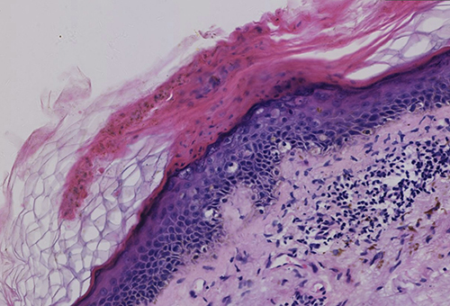 Figure 2 Epidermal hyperplasia with focal dyskeratosis, visible as a plate of dyskeratosis (HE, x100).