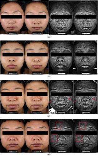 Figure 5. Comparison between pre- and post-operation facial images: blank group (a), negative control group (b), TCM formula group (c) and positive control group (d).