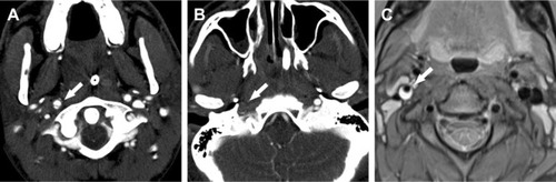 Figure 4 Image of traumatic carotid artery dissection on the right side.