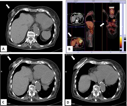 Figure 4 CT-guided cryoablation of large invasive carcinoma of the right breast in 83-year-old woman not suitable for surgery due to co-morbidities. (A) Large tumor mass in the right breast with nipple retraction. (B) PET-FDG/CT imaging showing an abnormal area of18F-FDG uptake in the right breast. (C) CT-guided placement of the cryoprobe. (D) Complete ablation of the tumor during the freezing process.
