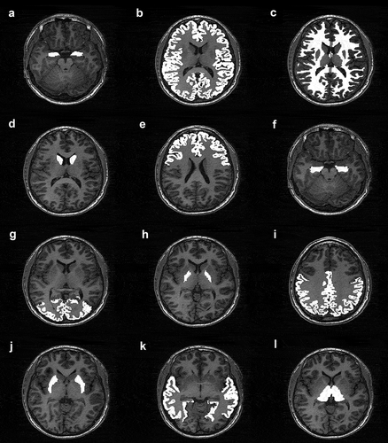 Figure 2. illustration of the cerebral parcellation using the software freesurfer (http://surfer.nmr.mgh.harvard.edu) used to divide the pseudo-continuous ASL(pCASL) data into total gray and white, the former divided into 20 gray matter regions, providing a mean cerebral blood flow (CBF) value for each region. Two scans were performed on each study participant, and the mean of the two scans was calculated for each region in each subject. The mean value, standard deviation and confidence interval for each region and each group are shown in Table 3. a. amygdala, b. total grey matter, c. total white matter, d. caudate nucleus, e. frontal lobe gray mater, f. hippocampus, g. occipital lobe gray matter, h. globus pallidum, i. parietal lobe gray matter, j. putamen, k. temporal lobe gray matter, l. thalamus.