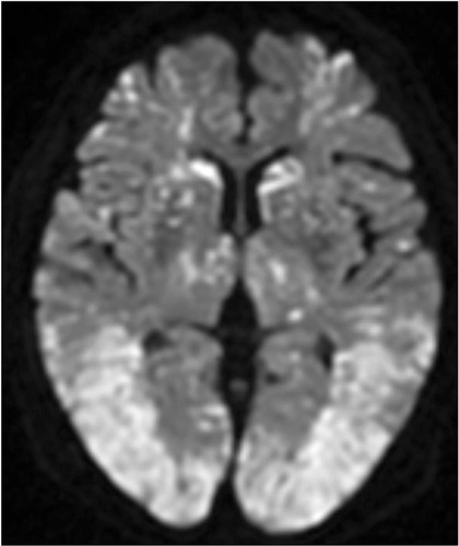 Figure 4 Follow-up brain magnetic resonance imaging. Diffusion-weighted imaging showing the exacerbation of disseminated, hyperintense dot-like lesions in the brain.