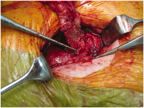 Figure 2. Surgical revision of ileal conduit with mesh eroded into the lumen of the conduit.