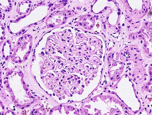 FIGURE 2. Membranous glomerulopathy. Evident generalized diffuse thickening of the capillary walls due to deposits within glomerular basement membrane (H&E, × 400).