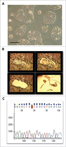 Figure 1. Isolation and characterization of the primary PDAC cell line NFCR01. (A) Micrograph of a pure population of epithelial PDAC cells, as obtained via contrast phase light microscopy (Original magnification 20×, scale bar = 50 μm). (B) Micrographs of laser microdissected epithelial cells from a PDAC fresh tissue to perform DNA extraction (Original magnification 10×). (C) K-ras gene mutation analysis of isolated cells showing G216T mutation in codon 12 of exon 2.