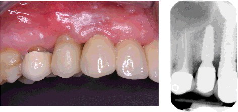 Figure 3. Prosthetical part and check-up X-ray.