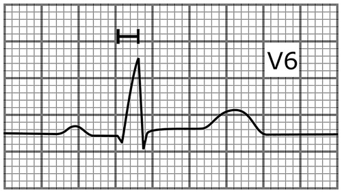 Figure 1. A schematic illustration presenting lead V6 of an ECG with delayed intrinsicoid deflection (time from the onset of the QRS complex to R-wave peak in lead V5 or V6 ≥ 0.05s). The paper speed is 50 mm/s.